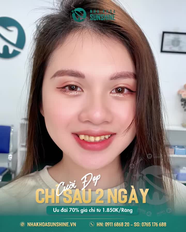 "TÂN TRANG NỤ CƯỜI THẦN TỐC — CƯỜI ĐẸP RẠNG RỠ CHỈ SAU 2 NGÀY!"
