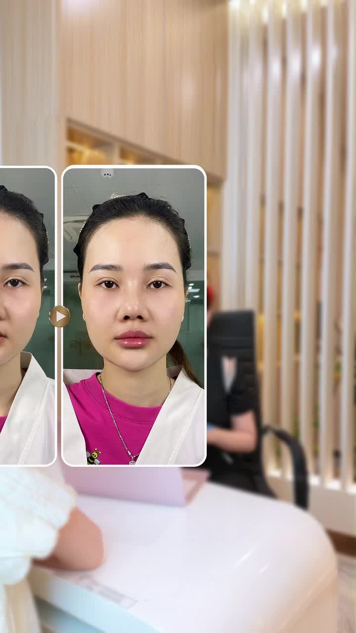 Rãnh mắt xuất hiện khi còn trẻ, đâu là hướng cải thiện phù hợp?