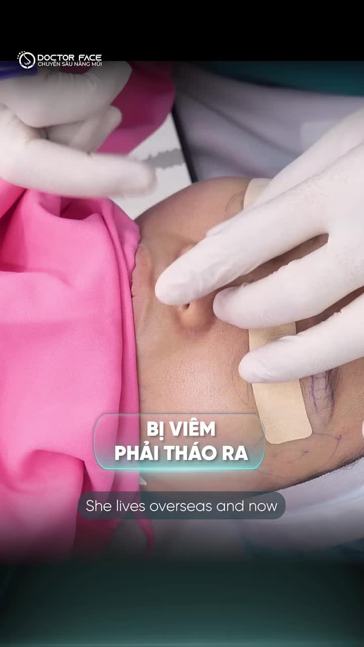 Từng nâng mũi nhưng không đạt kết quả như mong muốn. Lần sửa lại này, chị chỉ mong một dáng mũi thấp và thật tự nhiên.