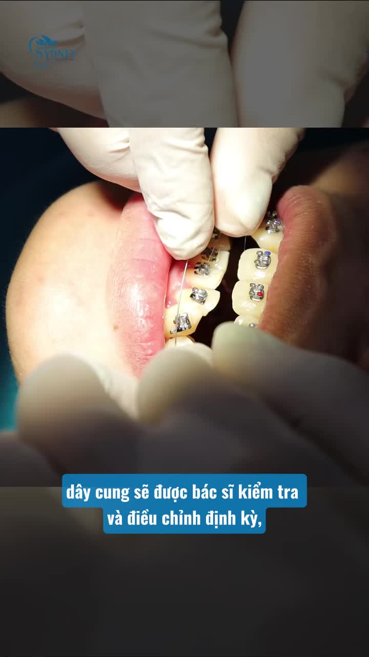 NIỀNG RĂNG BAO LÂU THÌ CẦN THAY DÂY CUNG?