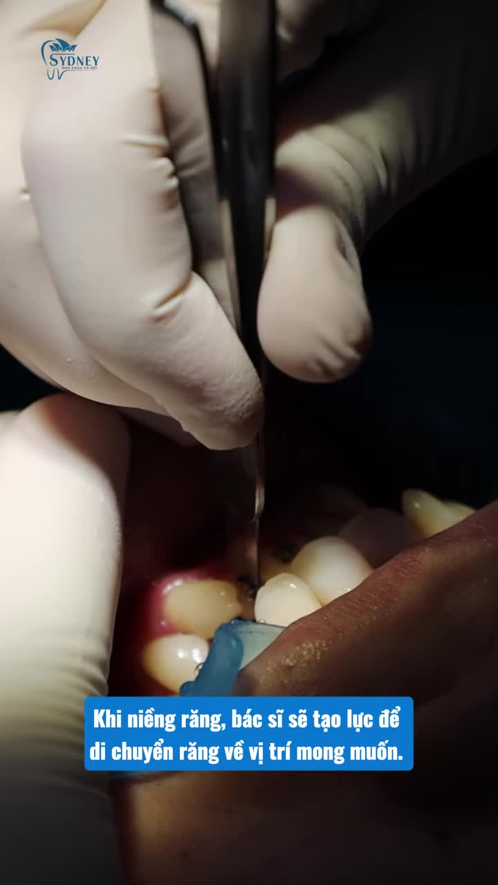 RĂNG ĐÃ BỌC SỨ CÓ THỂ NIỀNG RĂNG ĐƯỢC KHÔNG?