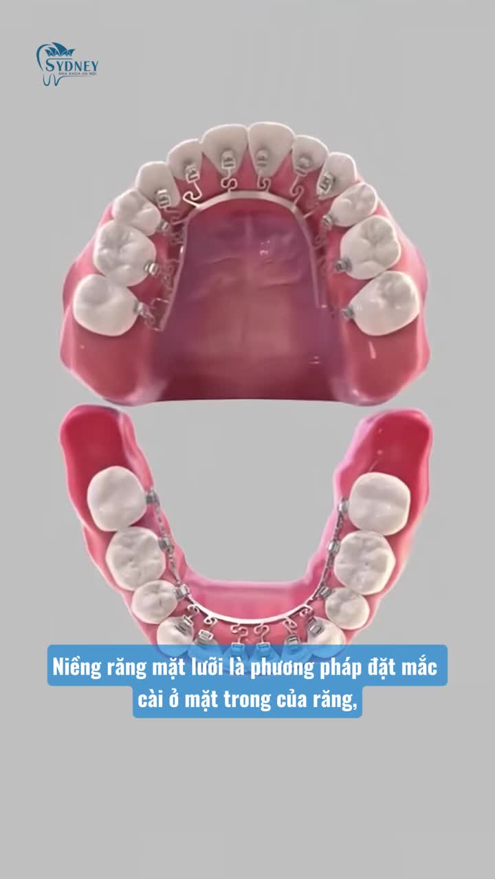 NIỀNG RĂNG MẶT LƯỠI: ƯU VÀ NHƯỢC ĐIỂM