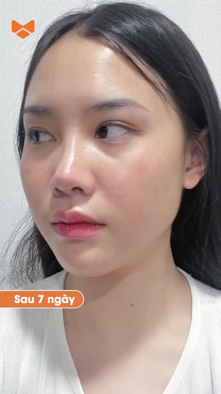 Sở hữu ngay khuôn mặt tỉ lệ vàng với độn cằm Vline