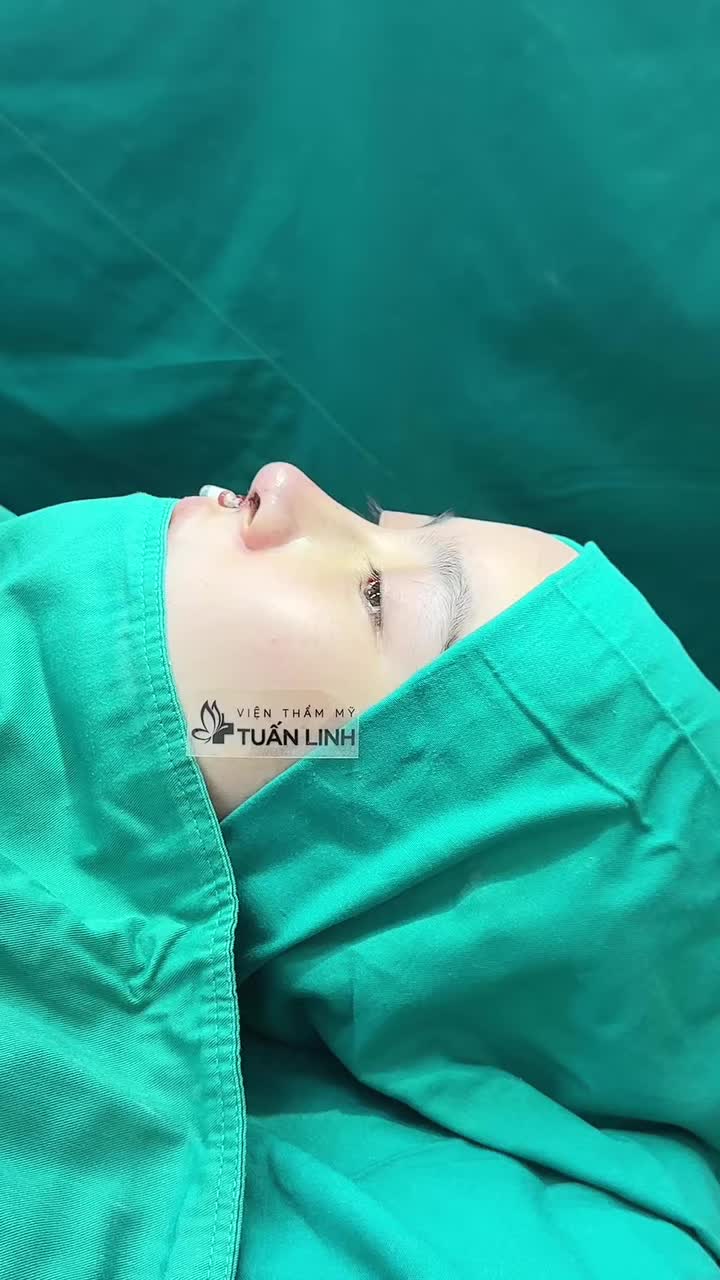 Dáng mũi được yêu cầu và form mũi sau làm.