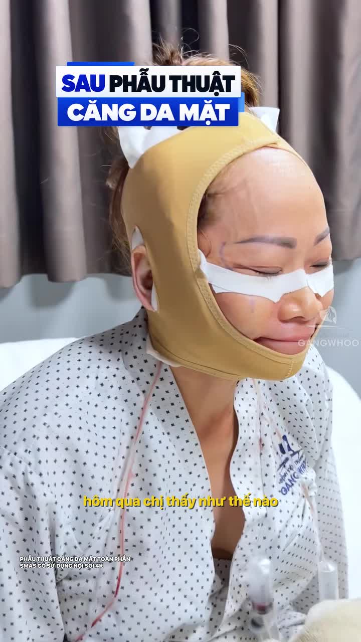 Sợ đau, sợ sưng, sợ kết quả không như mong muốn? Những nỗi lo trước khi căng da mặt Smas có sử dụng nội soi 4K đã được giải tỏa sau khi thực hiện tại Bệnh viện thẩm mỹ Gangwhoo.