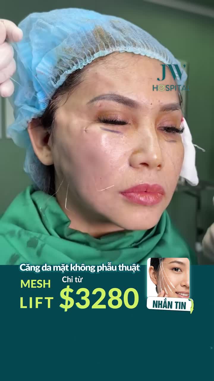 U50 VIỆT KIỀU MỸ VỀ JW CĂNG CHỈ MESH LIFT KHÔΝG PHẪU THUẬT, TRẺ 20 TUỔI, SẸO TÀNG HÌNH