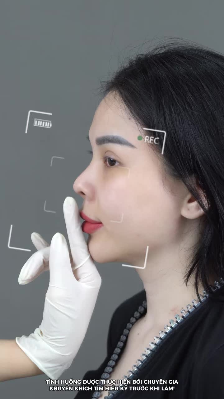 MỚI NÂNG MŨI, ĐỪNG VỘI LO KHI THẤY SÓNG MŨI CHƯA CAO NHƯ MONG ĐỢI!
