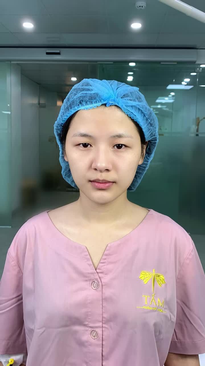 Mở góc mắt có ảnh hưởng đến tuyến lệ không?