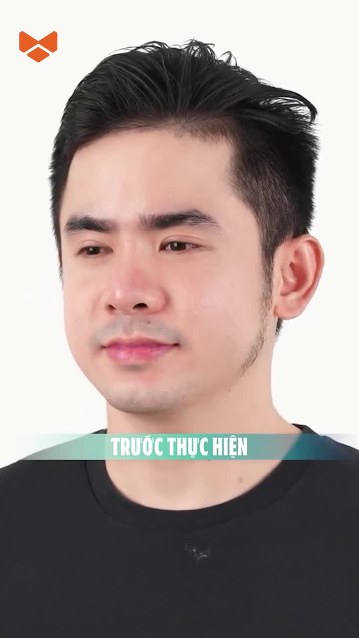Làm lại mũi thôi mà, có gì đâu mà ngại