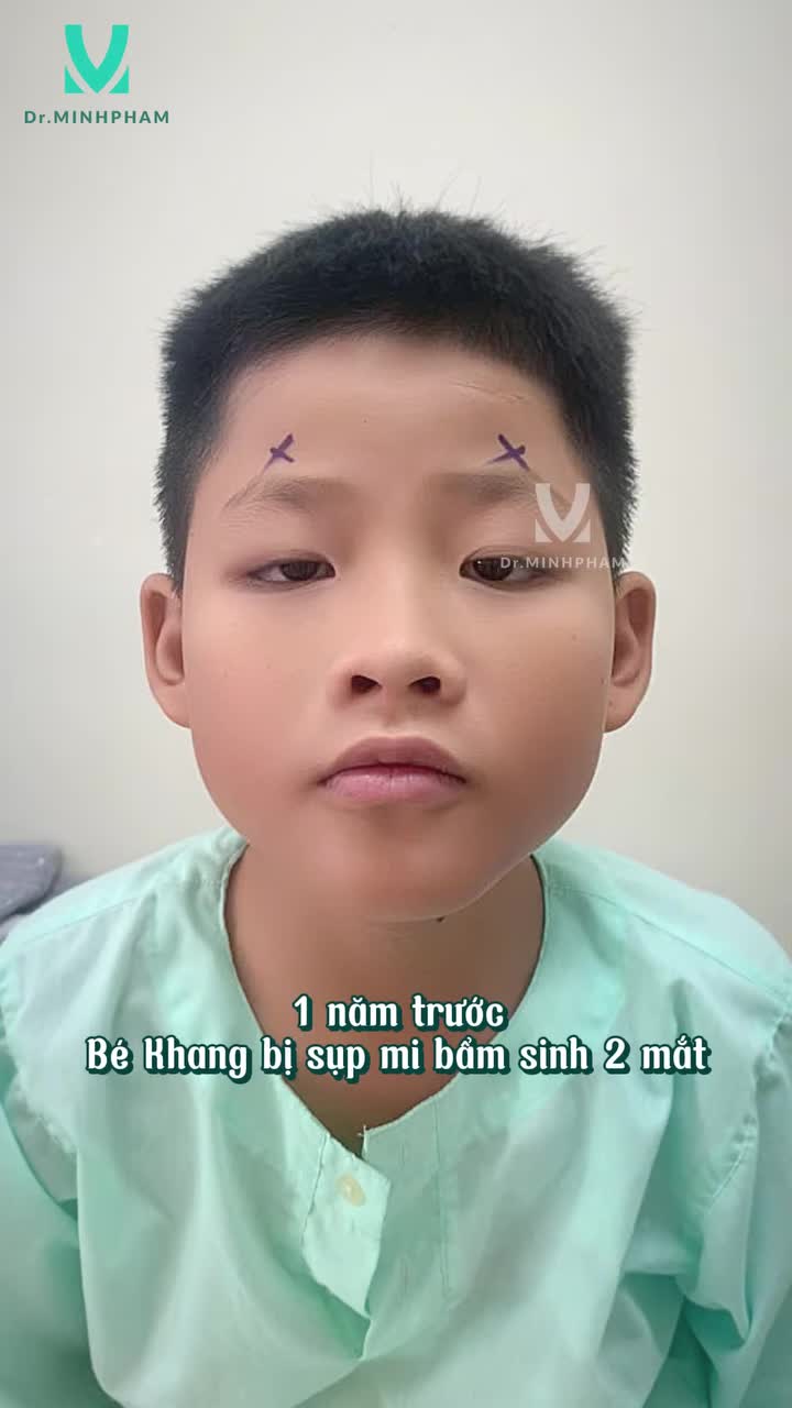 1 NĂM SAU TREO MI VCT – GĐ BÉ KHANG VẪN GỬI FEEDBACK CHO EKIP DR. MINH PHẠM