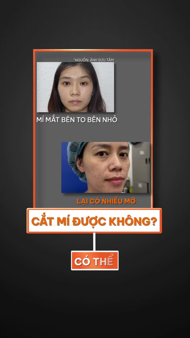 Phương pháp nào sẽ phù hợp với tình trạng mí bên to bên nhỏ nhiều mỡ???