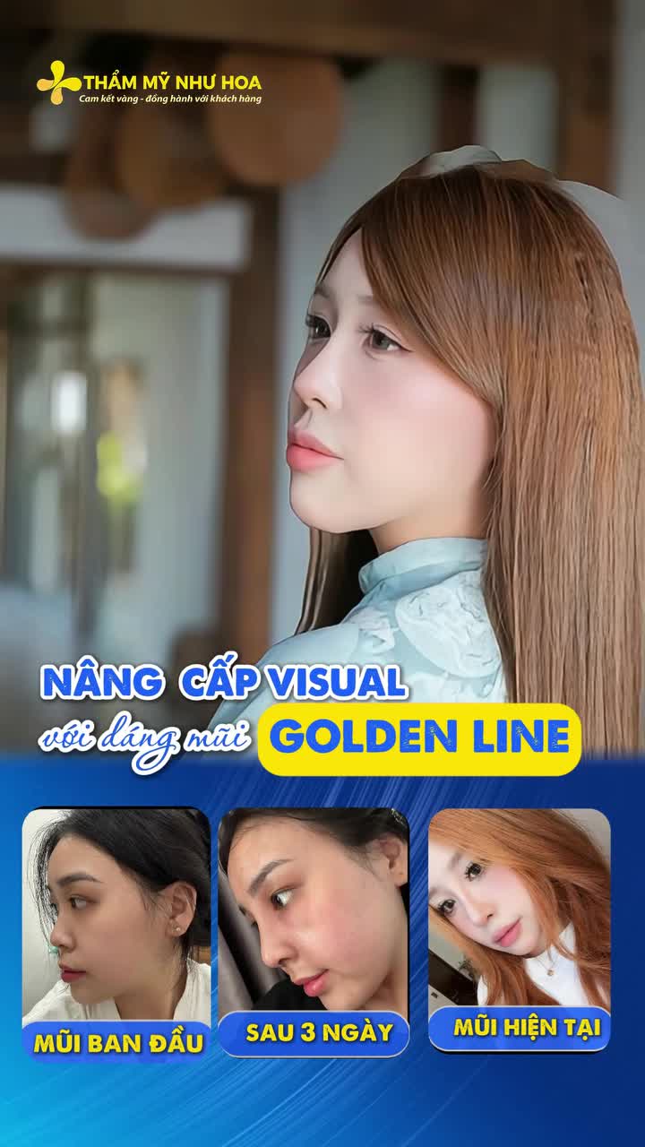Từ dáng mũi có sống hơi thấp, được mẹ và hội chị em nhiệt tình “đẩy thuyền”, chị đẹp Bảo Châu quyết định nâng mũi Golden Line.