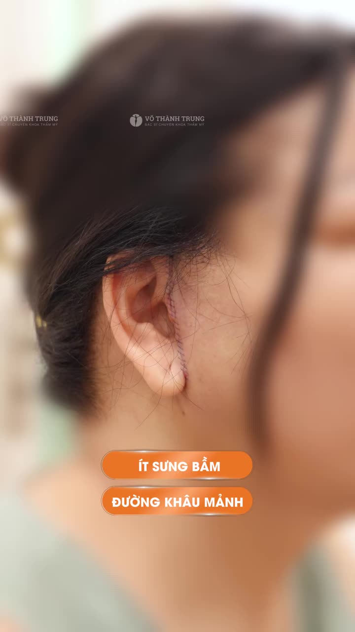 Hình ảnh thực tế sau 2 ngày phẫu thuật căng da mặt: đường khâu gọn, sưng bầm ở mức nhẹ và đang tiếp tục hồi phục