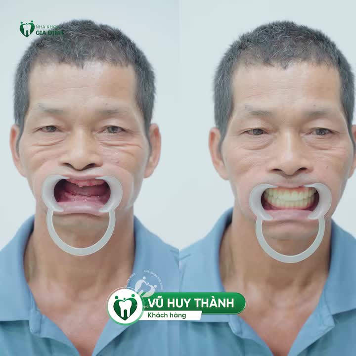 TOP 5 CHÚ KHÁCH HÀNG ĐÃ HOÀN TẤT QUÁ TRÌNH TRỒNG RĂNG IMPLANT TẠI NHA KHOA GIA ĐÌNH