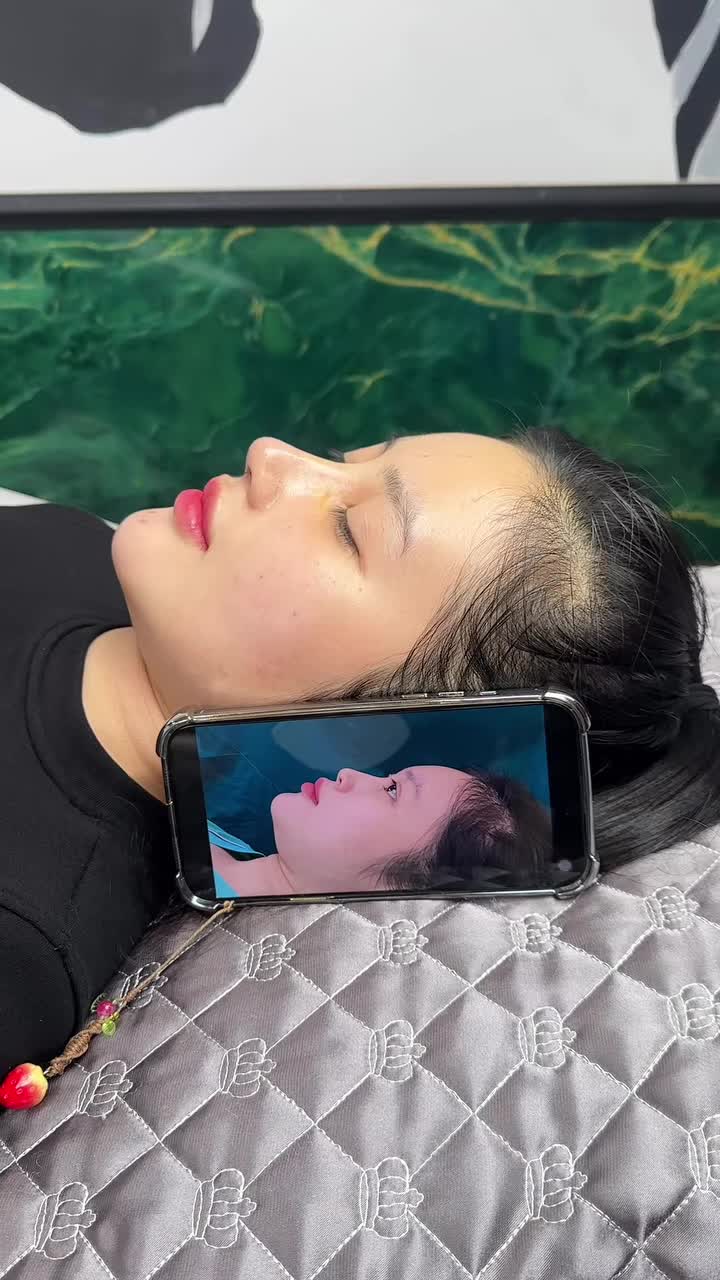 Mũi cấu trúc độn nền sau 5 ngày