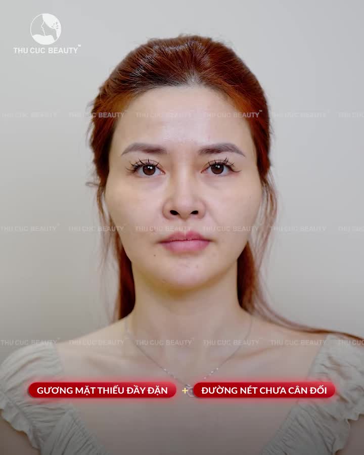 BÙNG NỔ SIÊU ƯU ĐÃI – DÀNH TẶNG 20 SUẤT FILLER TC CHO CHỊ EM!
