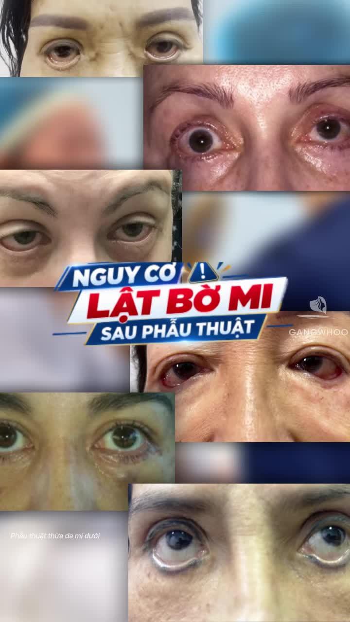 Có những ca chỉnh mí dưới, điều bác sĩ cần đánh giá trước tiên là nguy cơ lật bờ mi sau phẫu thuật