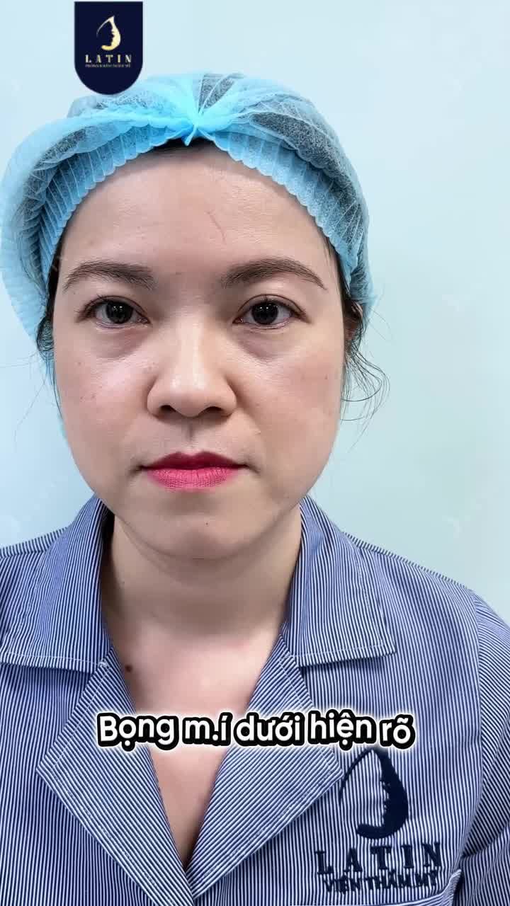 LẤY LẠI ĐÔI MẮT KHÔNG TUỔI NHỜ COMBO CẮT MÍ DƯỚI - CẤY RÃNH LỆ!