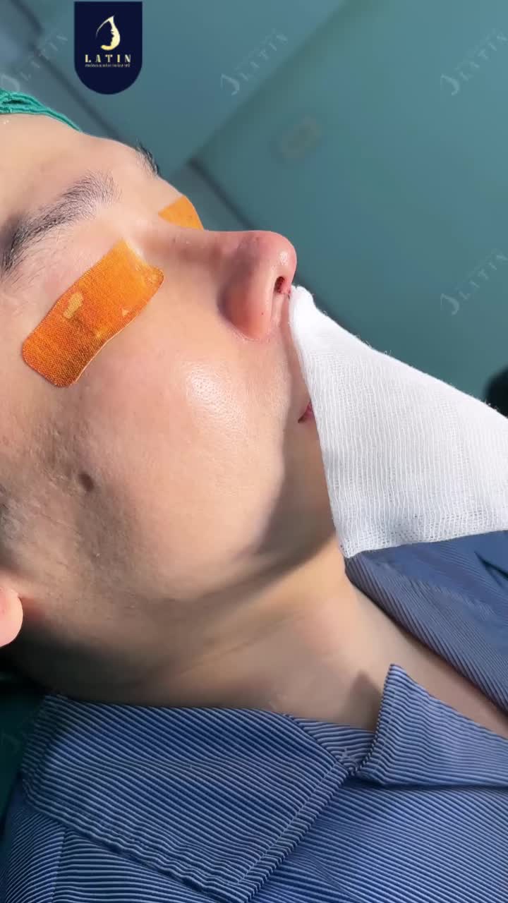 DÁNG MŨI L-LINE – ĐỊNH HÌNH GÓC NGHIÊNG NAM TÍNH