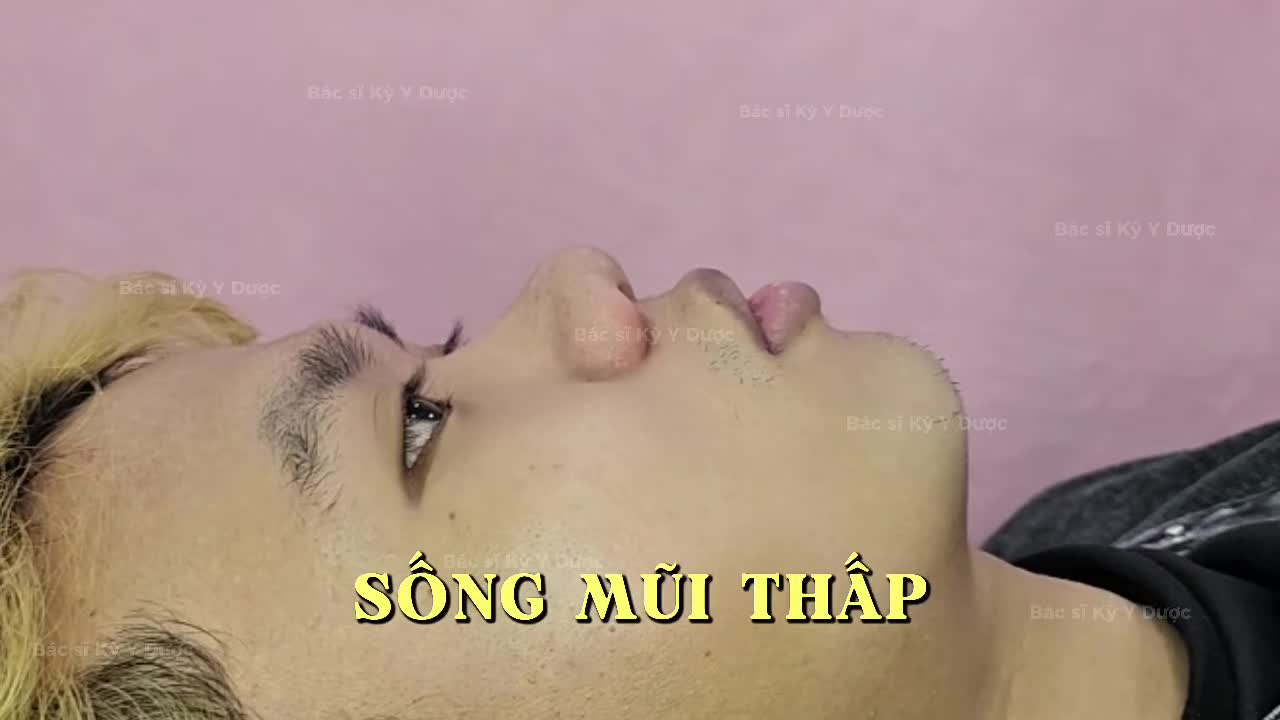 VIDEO CHÂN THẬT: TRƯỚC SAU 30 PHÚT TẠO HÌNH MŨI