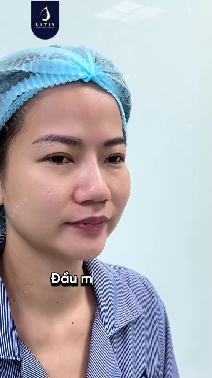 VÌ SAO NÂNG MŨI CHỈ VẪN PHẢI RÚT RA ĐỂ LÀM CẤU TRÚC