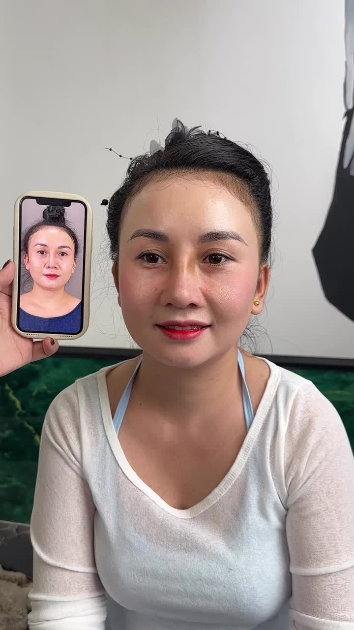 Mũi cấu trúc sửa lại sau 10 ngày
