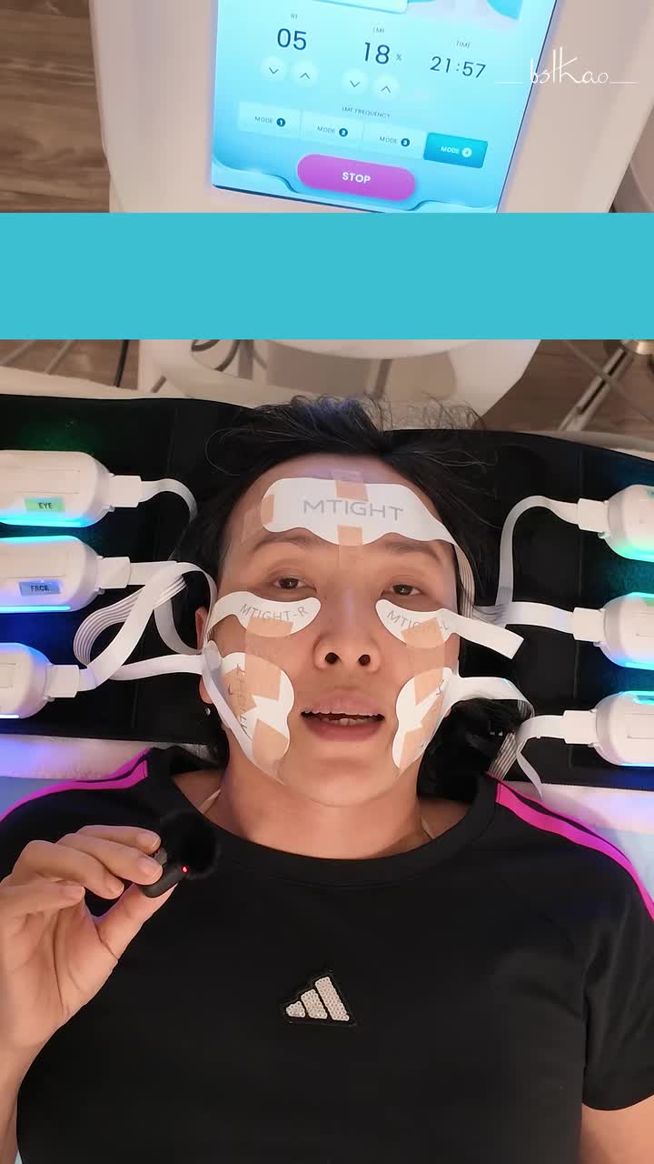 Tại sao tiêm botox 1 thời gian dài sau vẫn thấy có nếp nhăn? Phải chăng B.otox bị "lờn" đi? Cơ bị chai?