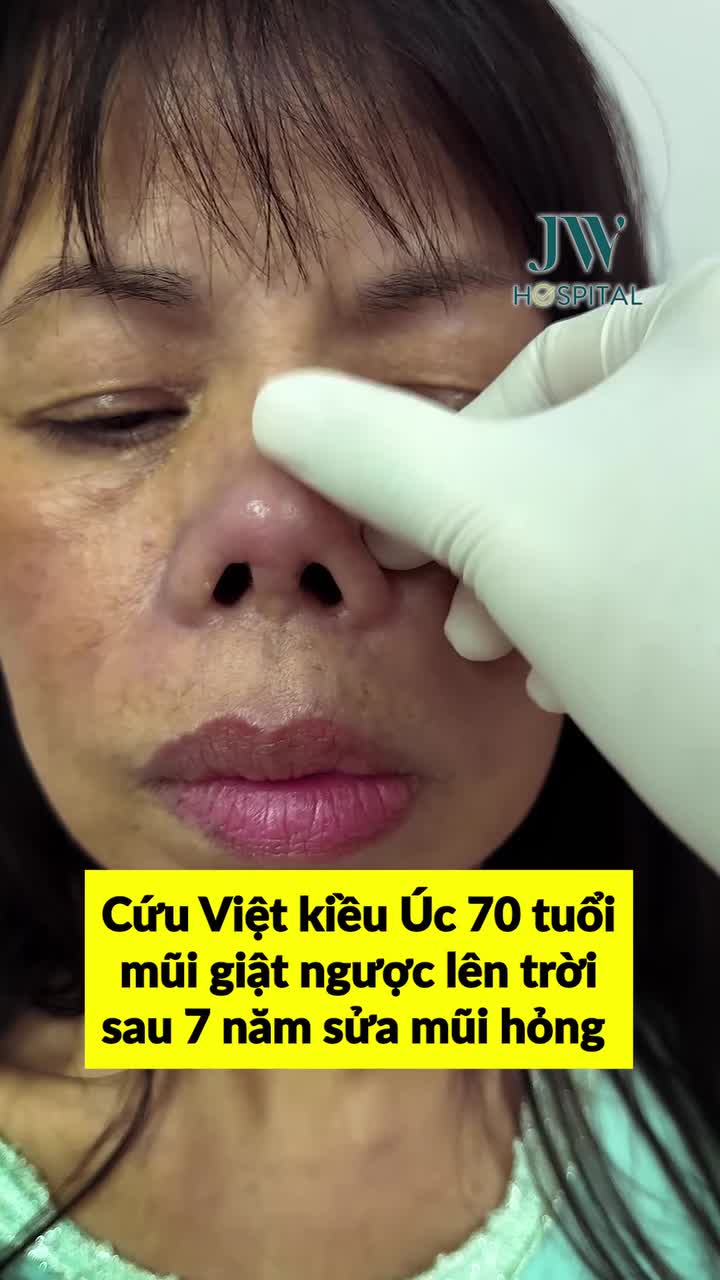BÁC SĨ TÚ DUNG NÂNG MŨI SỤN SƯỜN "GIẢI CỨU" VIỆT KIỀU ÚC U70 MŨI CO RÚT, GIẬT NGƯỢC SAU 7 NĂM SỬA HỎNG