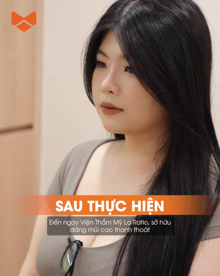 “Lột xác” với dáng mũi cao thanh thoát