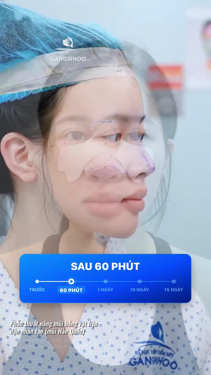 "Biết vậy nâng mũi sớm hơn" - Chia sẻ của khách hàng sau 15 ngày nâng mũi