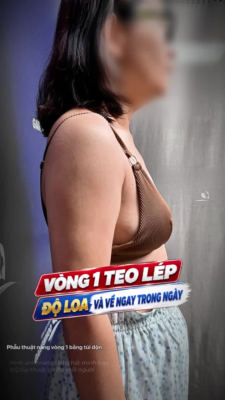 Vòng 1 teo lép sau sinh và những chia sẻ trải nghiệm sau "độ loa" của chị khách hàng mới thực hiện xong ca phẫu thuật chỉ sau 3 tiếng, không đau, về ngay trong ngày
