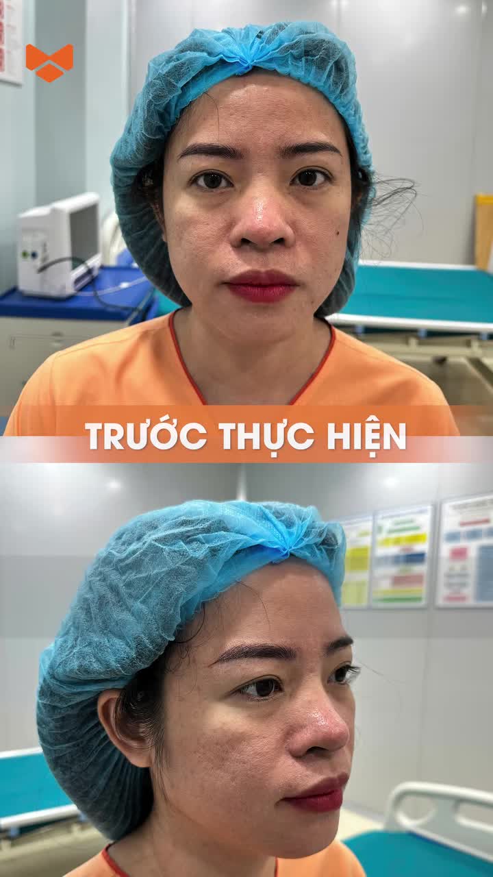 Thay đổi góc nghiêng siêu phẩm sau khi Nâng mũi