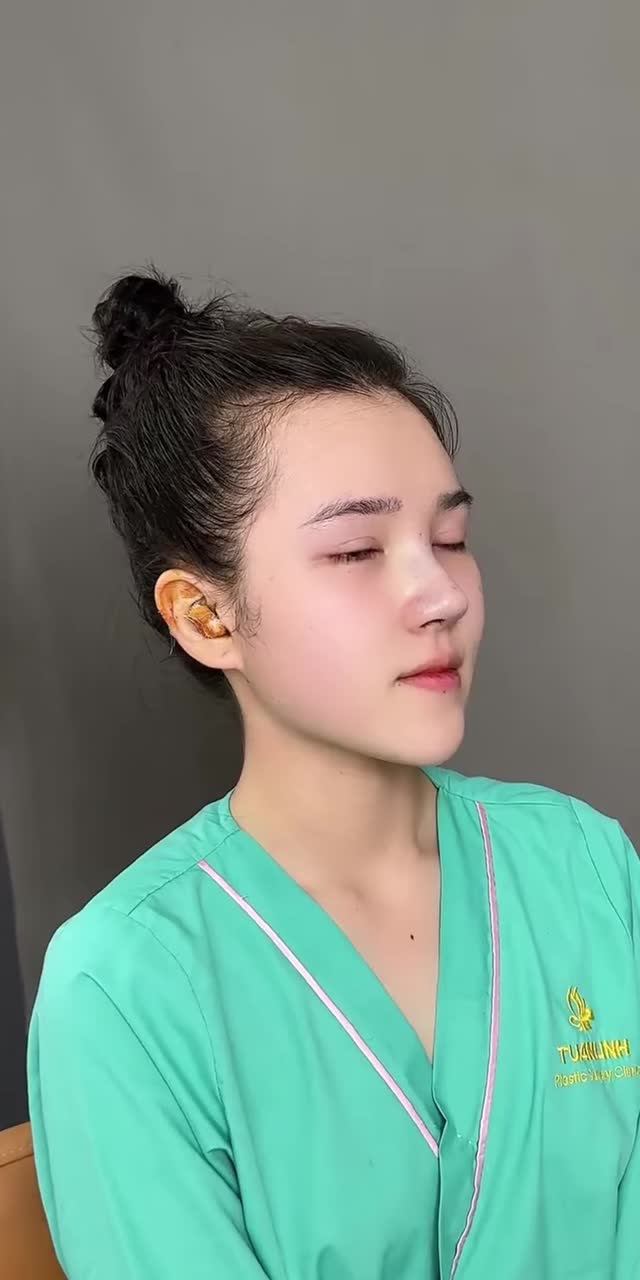 NÂNG MŨI BỌC SỤN – NHAN SẮC THĂNG HẠNG CHỈ TỪ 17