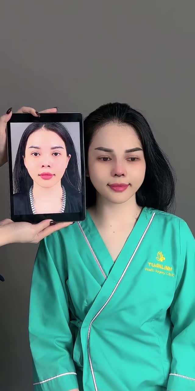 CA NÂNG MŨI CẤU TRÚC SỬA LẠI – TỪ DÁNG MŨI CAO ĐƠ ĐẾN DIỆN MẠO HÀI HÒA HƠN