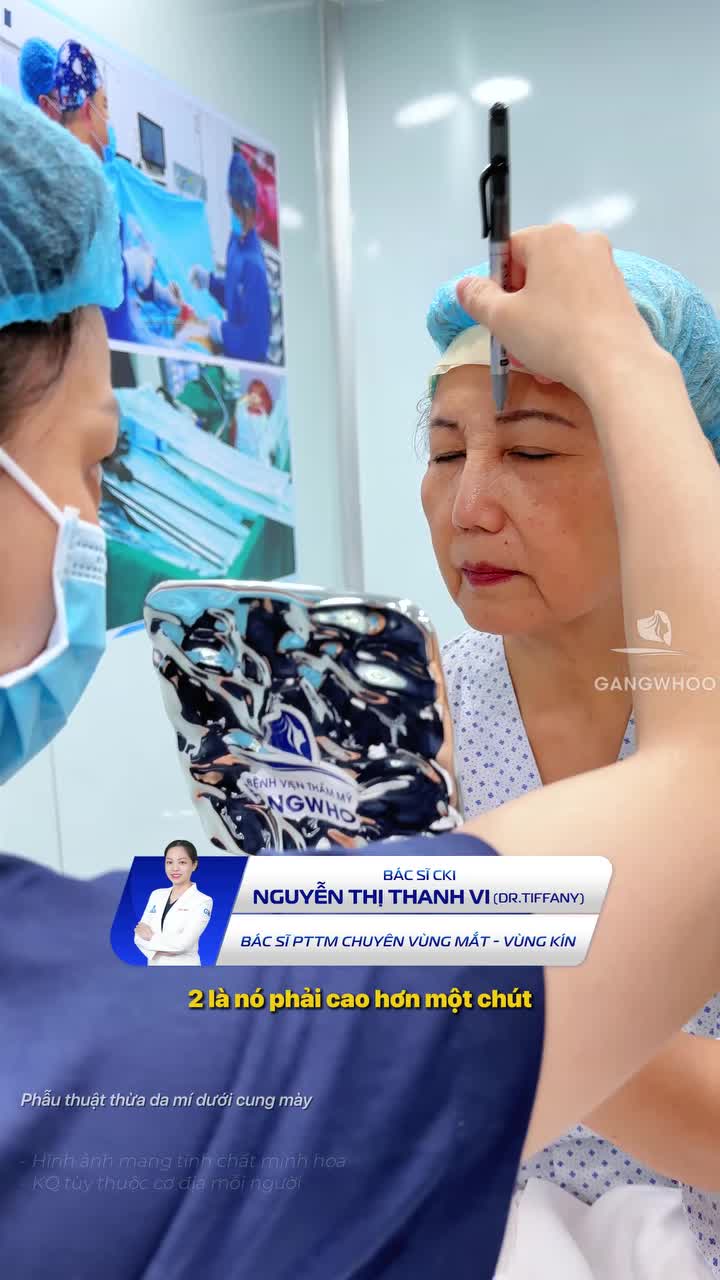 Da chùng che khuất tầm nhìn và kết quả sau 7 ngày cắt da thừa dưới cung mày