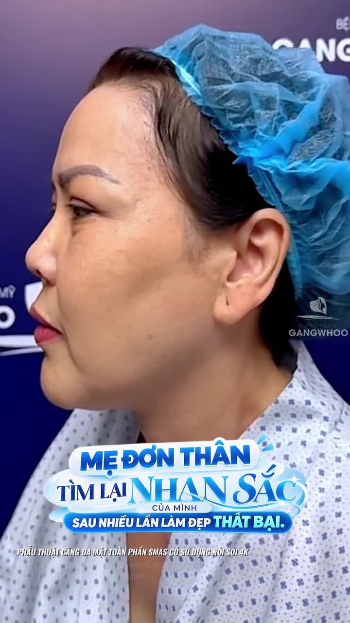 Một hành mới được bắt đầu tìm lại vẻ đẹp tự tin của chính mình với phẫu thuật căng da mặt toàn phần Smas có sử dụng nội soi 4K
