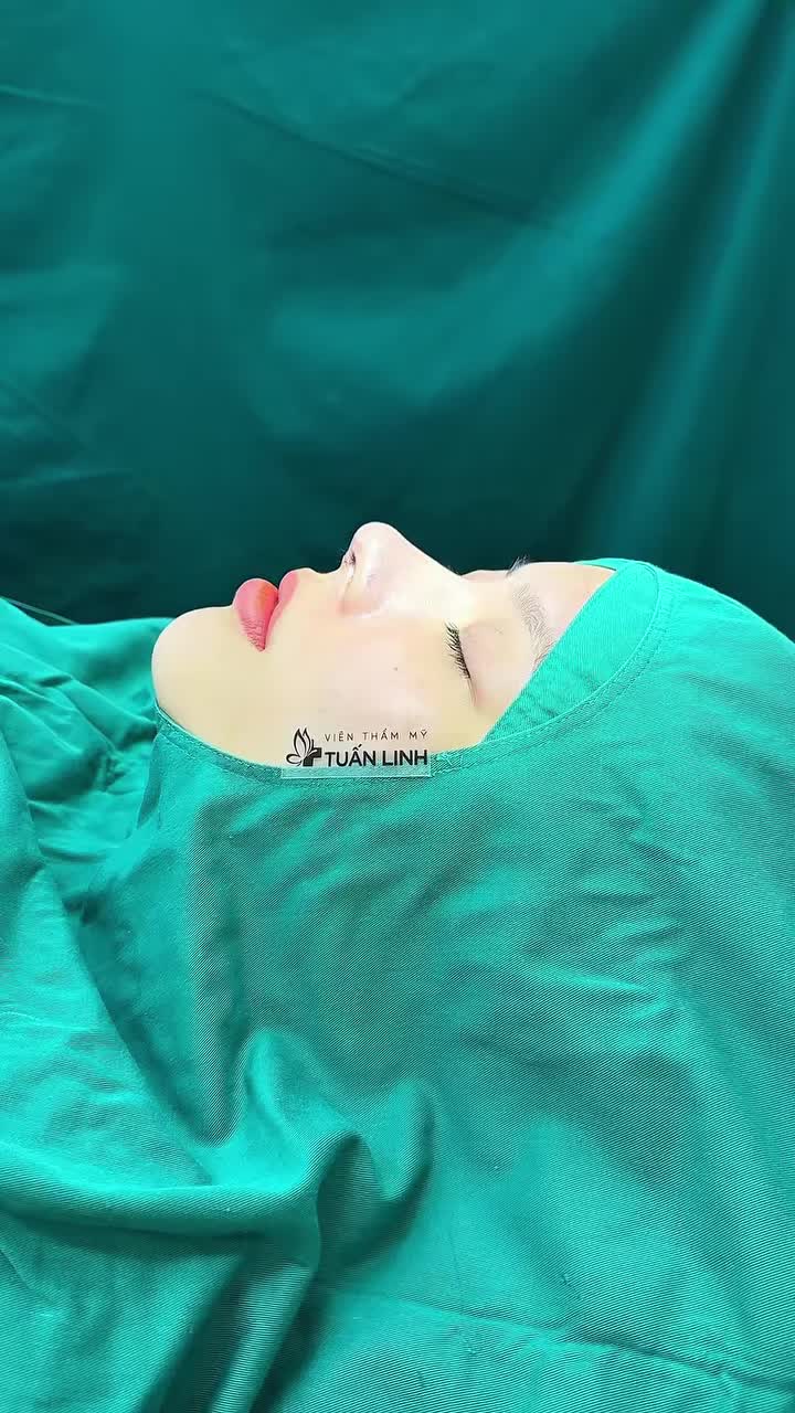Nâng mũi cấu trúc Surgiform sau Pt