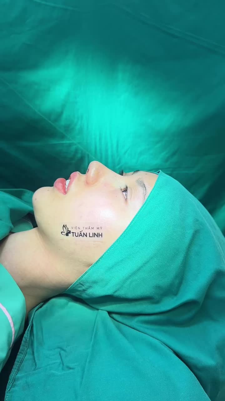 Mũi cấu trúc sau phẫu thuật