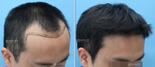 Hình ảnh Cấy tóc: Cấy tóc FUE 1989 nang, nam 37 tuổi, kết quả sau 8 tháng - case 4 - Viện Cấy Tóc Absolute Hair Clinic