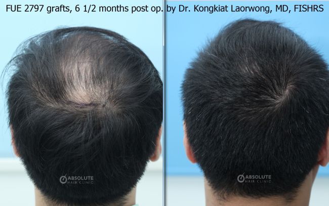 Hình ảnh Cấy tóc: Cấy tóc FUE 2797 nang, nam 27 tuổi, kết quả sau 6.5 tháng - case 7 - Viện Cấy Tóc Absolute Hair Clinic