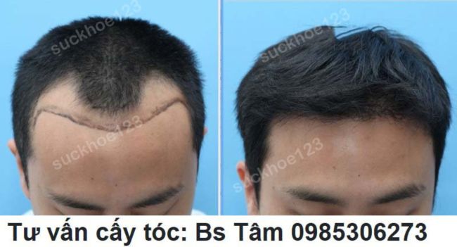 Hướng dẫn chăm sóc sau cấy tóc tự thân