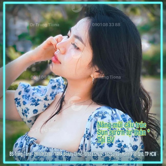 Nâng Mũi Sụn Sườn Tự Thân Giá Bao nhiêu, Ưu điểm và Lưu Ý