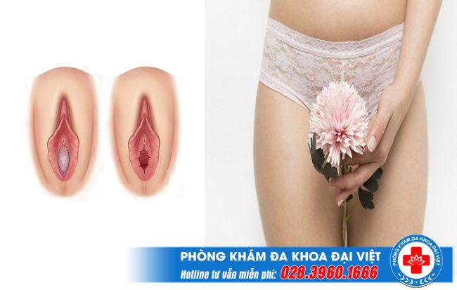 Vá màng trinh ở đâu an toàn? Chi phí vá màng trinh có đắt không?