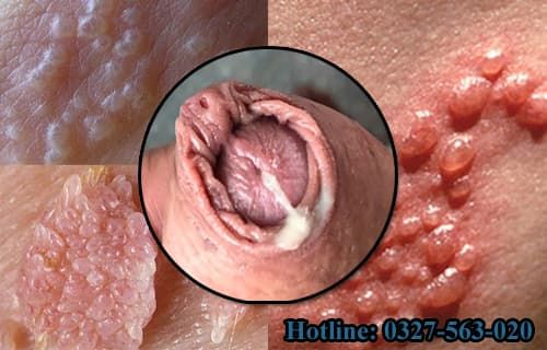 Dùng bao cao su có ngăn ngừa được bệnh tình dục không?