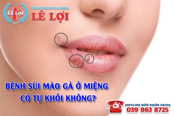 Sùi mào gà ở miệng có tự khỏi không?