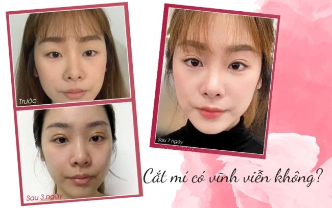 Cắt mí có được vĩnh viễn không? Các yếu tố ảnh hưởng - Seoul Center