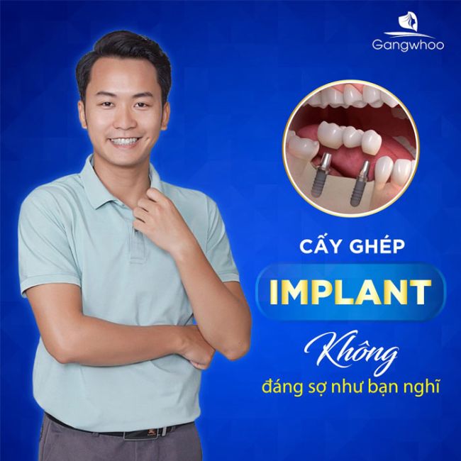 Cấy Ghép Implant Răng Cửa Sử Dụng Kỹ Thuật Thế Nào?