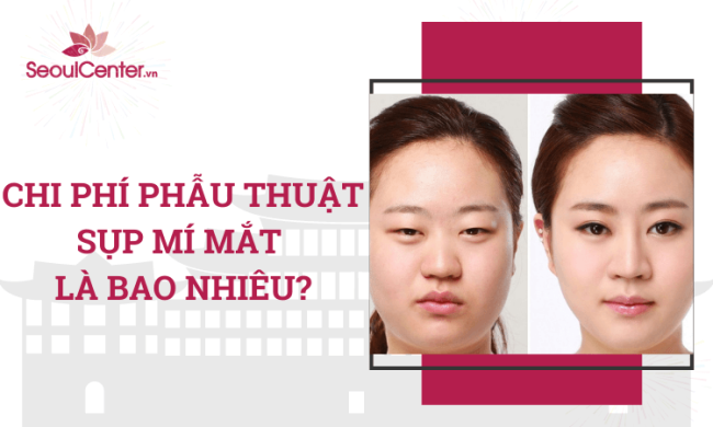 Chi phí phẫu thuật sụp mí mắt bẩm sinh – Bảng giá cắt sụp mí mới nhất 2022