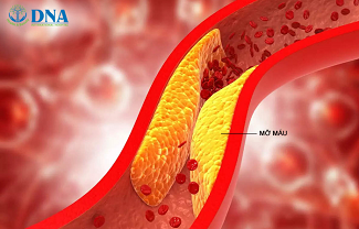 Lọc máu ngừa đột quỵ - Bí quyết sống khỏe mạnh, hạnh phúc và trường thọ chuẩn Nhật Bản ngay tại Việt Nam - Bệnh Viện Q