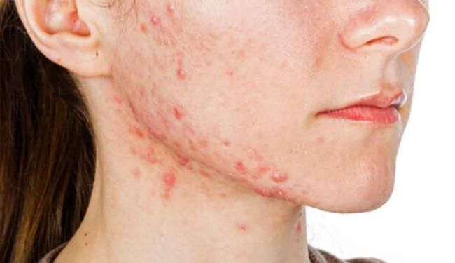 Mụn Trứng Cá Dạng Nang: Nguyên Nhân Và Cách Xử Lý An Toàn